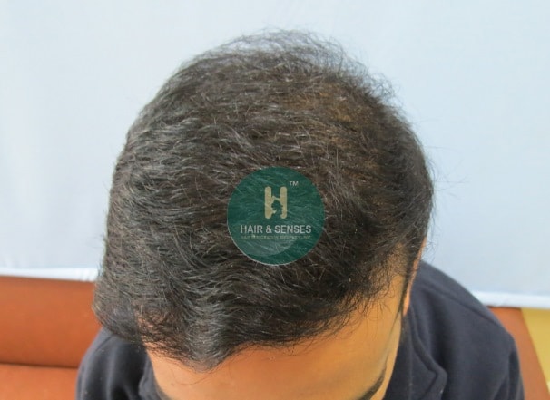 Hair Transplant Case Study